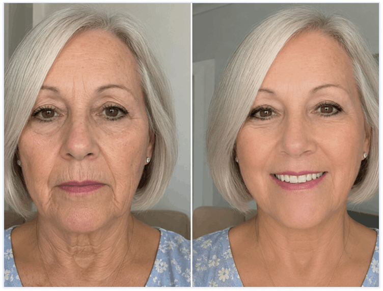 Botox alternative that actually works